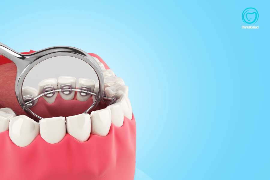 imagen 3d de ortodoncia lingual colocada por dentro del diente