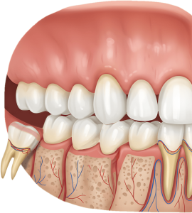 Ilustración médica detallada en sección transversal que muestra una muela del juicio inferior impactada creciendo horizontalmente y empujando contra la raíz y corona del segundo molar adyacente, con los nervios y vasos sanguíneos visibles.